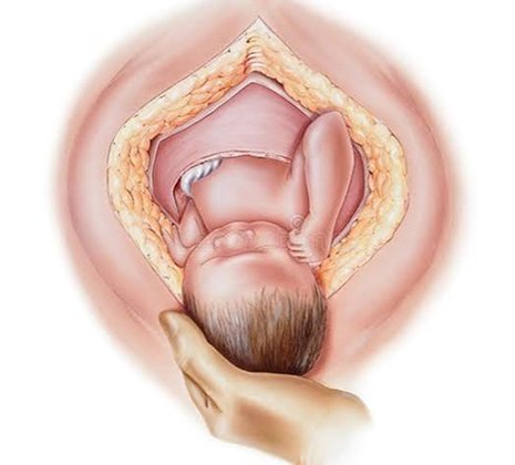 Caesarean Section (LSCS) Services
