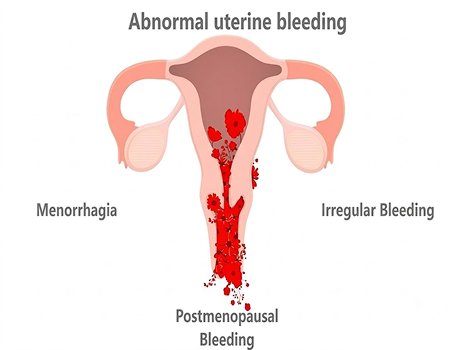 Menstrual & Abnormal Bleeding Management