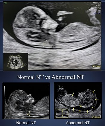 NT/NB & Pregnancy Screening Support