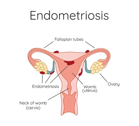 Ovulation & PCOD-Related Fertility Management