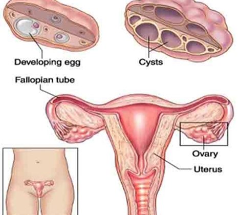 PCOS / PCOD Management