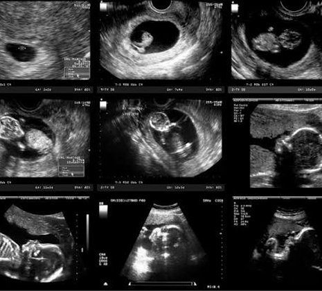 Pregnancy Sonography / Ultrasound